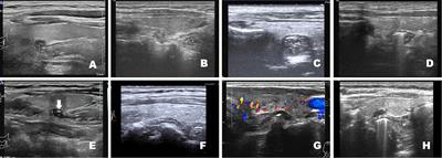 Frontiers Pharyngoesophageal diverticulum mimicking thyroid